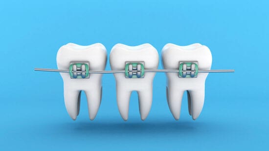 braces with brackets